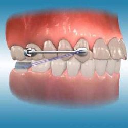 Traditional Orthodontics Amherst | Metal Braces | Orthodontist